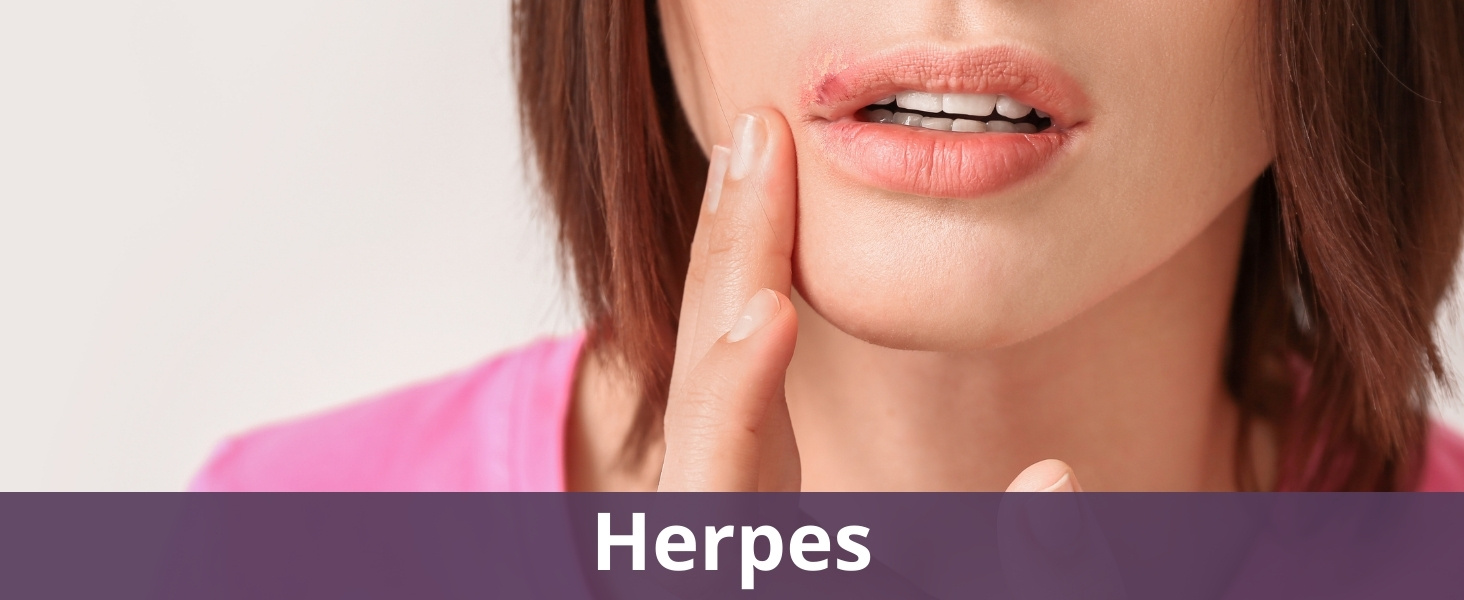 Herpes