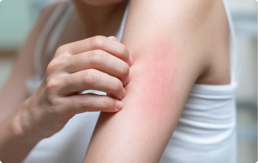 Kot olje za brazgotine in po draženju