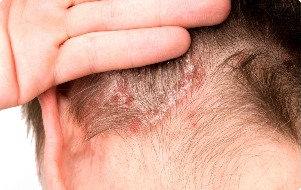 Psoriaza in druge kožne bolezni