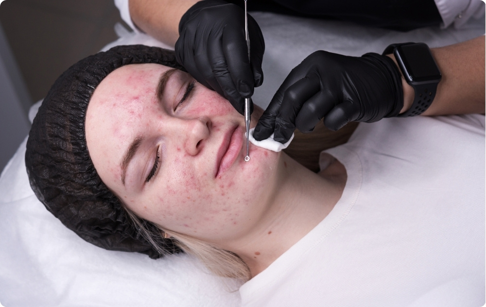 Profesionalni dermatološki posegi